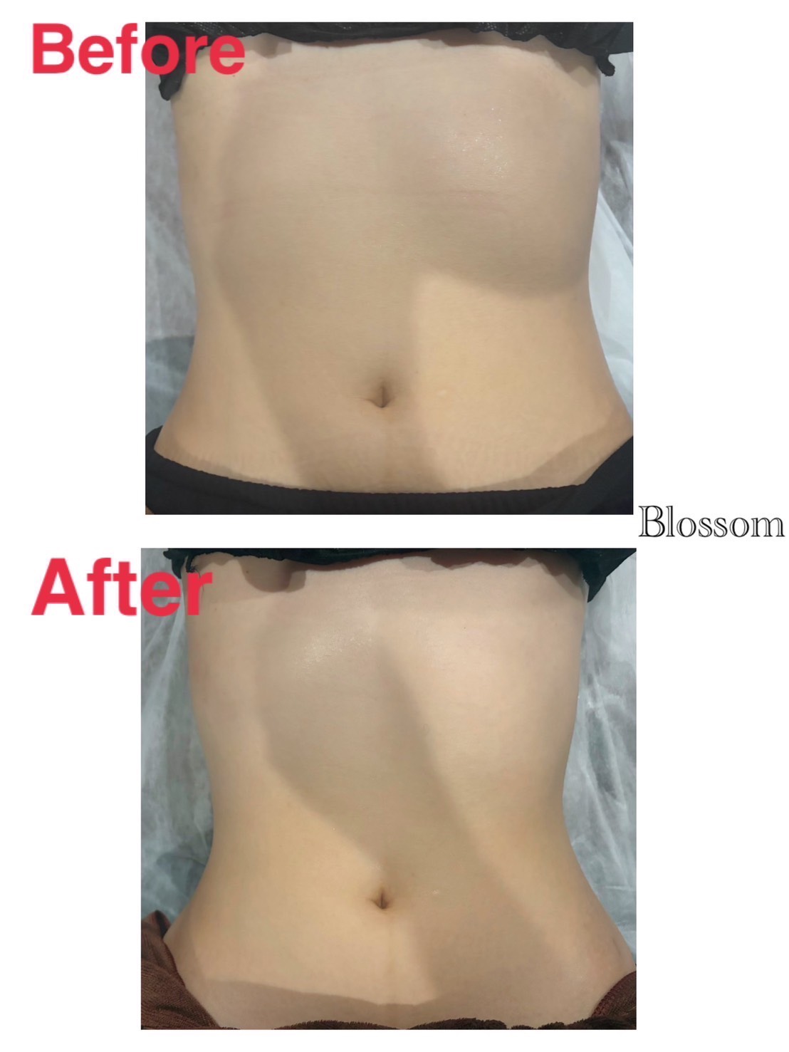 お腹の施術前と施術後